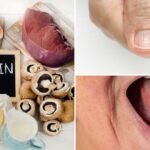 Vitamin B12 Deficiency