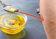 Say Goodbye to Varicose Veins: Discover the Power of Olive Oil & Garlic!