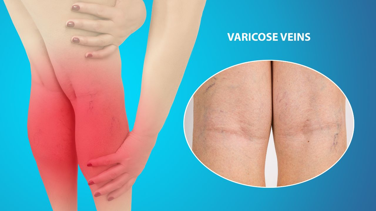 Varicose veins