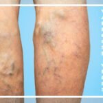 Essential Oils for Varicose Veins