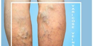 Essential Oils for Varicose Veins