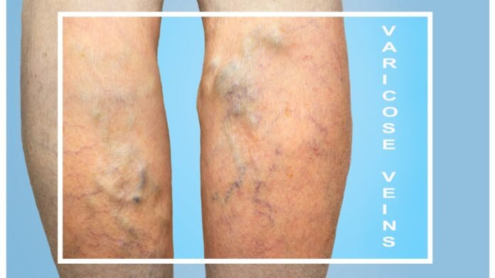 Essential Oils for Varicose Veins